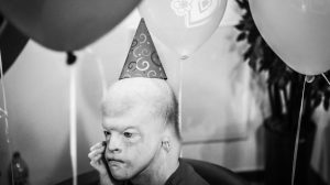 Mengabadikan Hidup Penyandang Sindrom Ablepharon-Macrostomia Mengabadikan Hidup Penyandang Sindrom Ablepharon-Macrostomia