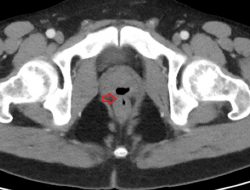 Akibat Gangguan Langka, Lelaki Ternyata Bisa Ejakulasi Lewat Pantat