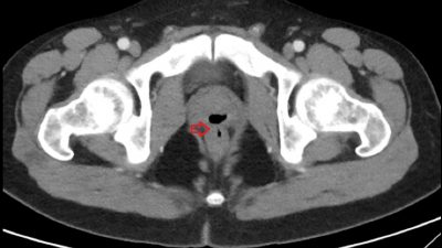 Akibat Gangguan Langka, Lelaki Ternyata Bisa Ejakulasi Lewat Pantat Akibat Gangguan Langka, Lelaki Ternyata Bisa Ejakulasi Lewat Pantat