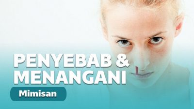 Penyebab Mimisan dan Pertolongan Pertama Mandiri yang Tepat Penyebab Mimisan dan Pertolongan Pertama Mandiri yang Tepat