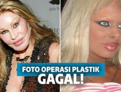 Duh! 15 Hasil Operasi Plastik Gagal Ini Malah Bikin Prihatin